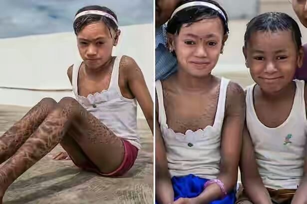 OMG! इन बच्चों की त्वचा है सांप की जैसे, उसे उतार देता है हर 10 दिन में