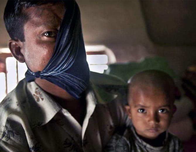 बाघ ने नोंच लिया था इस शख्स का चेहरा, 20 साल तक रखा छुपाकर दुनिया से!