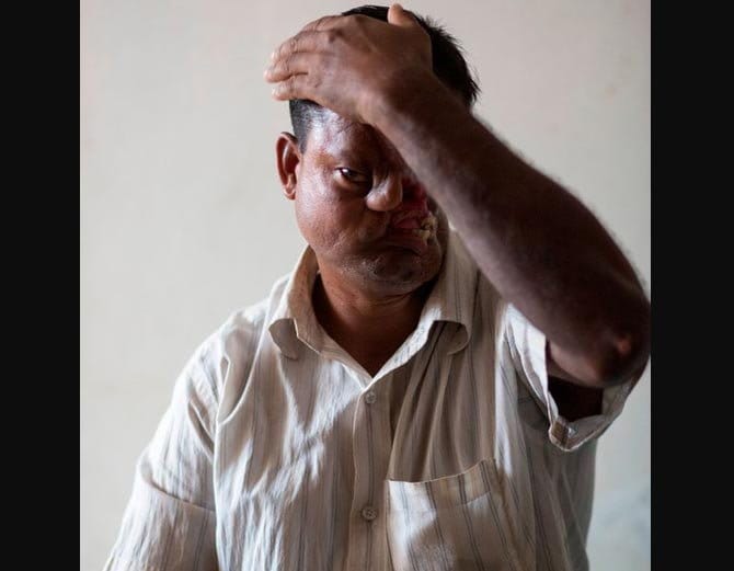 बाघ ने नोंच लिया था इस शख्स का चेहरा, 20 साल तक रखा छुपाकर दुनिया से!