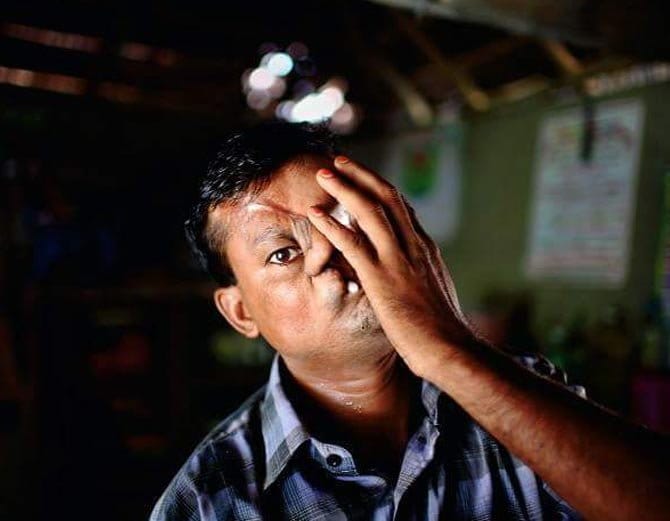 बाघ ने नोंच लिया था इस शख्स का चेहरा, 20 साल तक रखा छुपाकर दुनिया से!