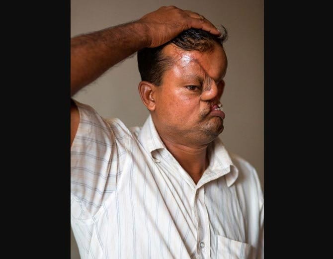 बाघ ने नोंच लिया था इस शख्स का चेहरा, 20 साल तक रखा छुपाकर दुनिया से!