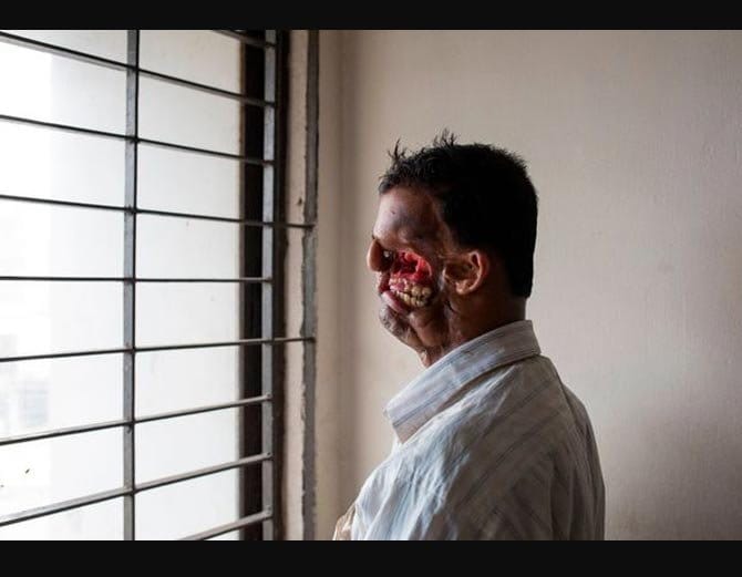 बाघ ने नोंच लिया था इस शख्स का चेहरा, 20 साल तक रखा छुपाकर दुनिया से!